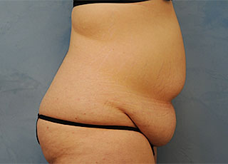 Tummy Tuck (Abdominoplasty)