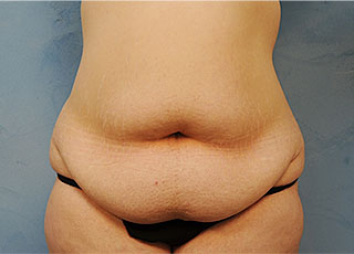 Tummy Tuck (Abdominoplasty)