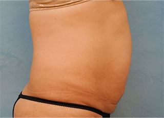 Tummy Tuck (Abdominoplasty)