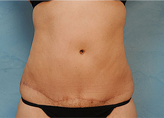 Tummy Tuck (Abdominoplasty)