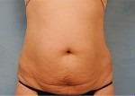 Tummy Tuck (Abdominoplasty)