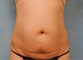 Tummy Tuck (Abdominoplasty)