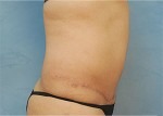 Tummy Tuck (Abdominoplasty)