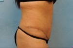 Tummy Tuck (Abdominoplasty)