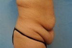 Tummy Tuck (Abdominoplasty)