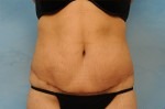 Tummy Tuck (Abdominoplasty)