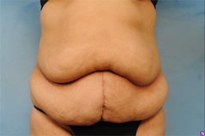 Tummy Tuck (Abdominoplasty)