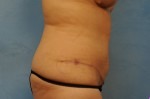 Tummy Tuck (Abdominoplasty)