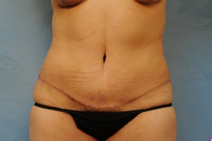 Tummy Tuck (Abdominoplasty)