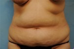 Tummy Tuck (Abdominoplasty)