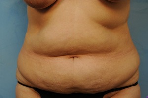 Tummy Tuck (Abdominoplasty)