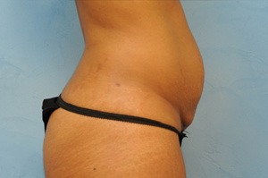 Tummy Tuck (Abdominoplasty)