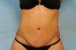 Tummy Tuck (Abdominoplasty)