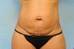 Tummy Tuck (Abdominoplasty)