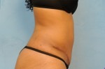 Tummy Tuck (Abdominoplasty)