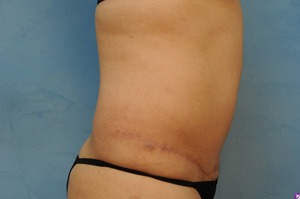 Tummy Tuck (Abdominoplasty)