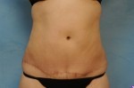 Tummy Tuck (Abdominoplasty)