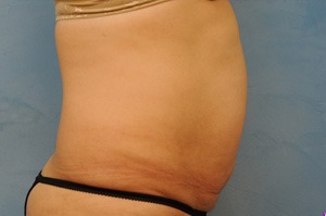 Tummy Tuck (Abdominoplasty)