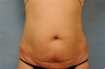 Tummy Tuck (Abdominoplasty)