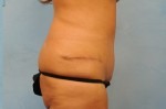 Tummy Tuck (Abdominoplasty)