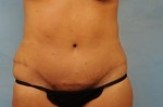 Tummy Tuck (Abdominoplasty)