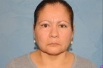 Upper Eye Lift (Blepharoplasty) Photos