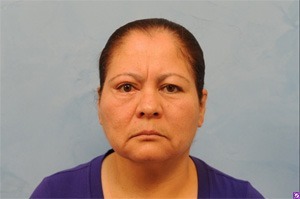 Upper Eye Lift (Blepharoplasty) Photos