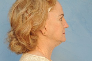 Facelift (Rhytidectomy)