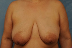 Breast Lift (Mastopexy)