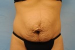 Tummy Tuck (Abdominoplasty)