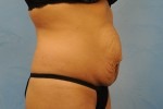 Tummy Tuck (Abdominoplasty)