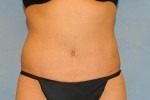 Tummy Tuck (Abdominoplasty)