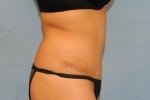 Tummy Tuck (Abdominoplasty)