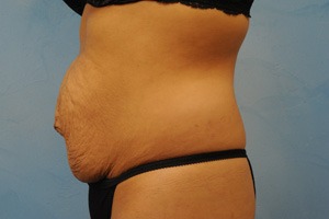 Tummy Tuck (Abdominoplasty)