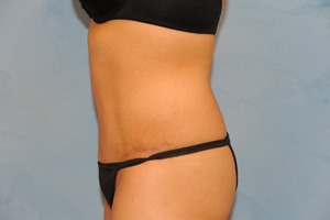 Tummy Tuck (Abdominoplasty)