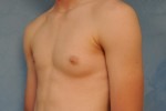 Gynecomastia
