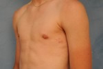 Gynecomastia