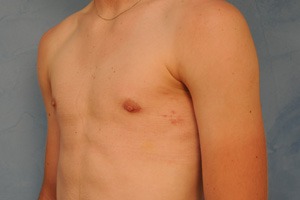 Gynecomastia