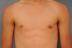 Gynecomastia