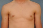 Gynecomastia