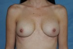 Breast Augmentation Revision