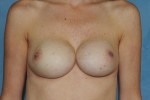 Breast Augmentation Revision