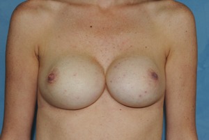 Breast Augmentation Revision