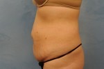 Tummy Tuck (Abdominoplasty)