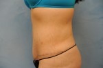 Tummy Tuck (Abdominoplasty)