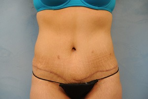 Tummy Tuck (Abdominoplasty)