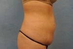 Tummy Tuck (Abdominoplasty)