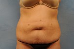 Tummy Tuck (Abdominoplasty)