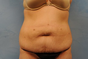 Tummy Tuck (Abdominoplasty)