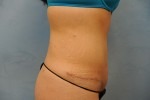 Tummy Tuck (Abdominoplasty)